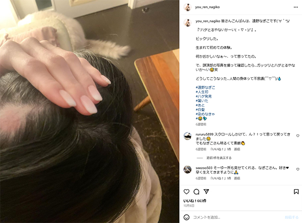 円形脱毛の遠野なぎこ