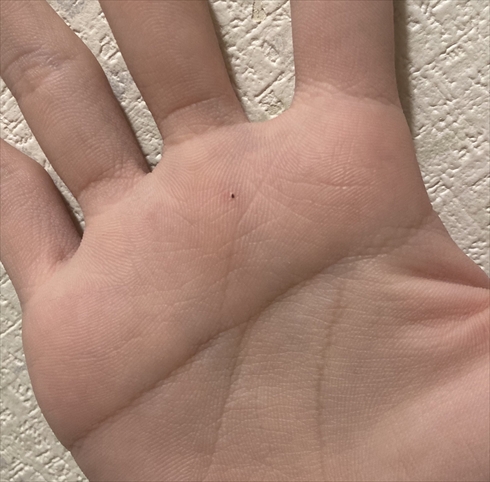手のひらにあるホクロだと思っていたもの