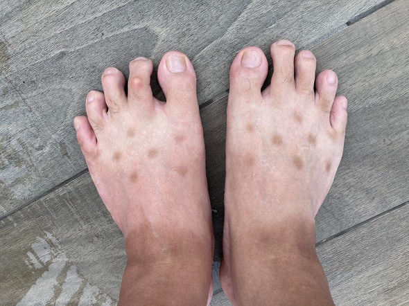 足の斑点