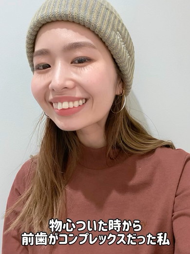 35歳から歯列矯正ビフォアフ