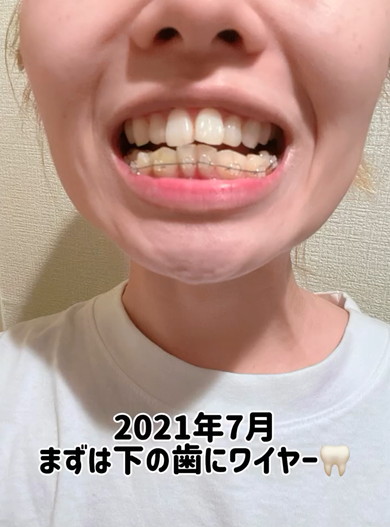 35歳から歯列矯正ビフォアフ