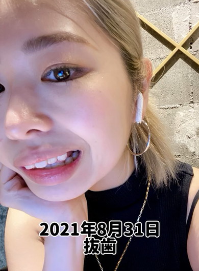 35歳から歯列矯正ビフォアフ