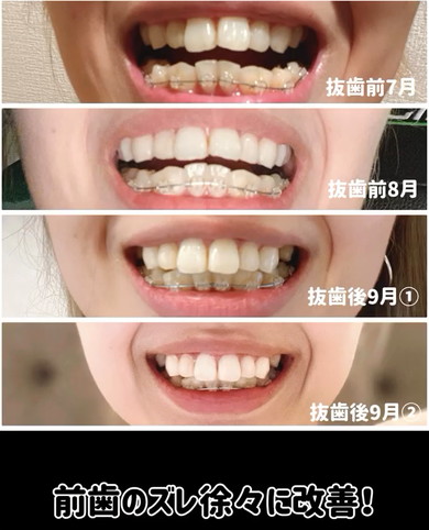 35歳から歯列矯正ビフォアフ