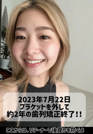 35歳から歯列矯正ビフォアフ