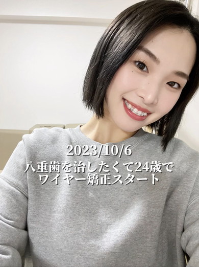 ワイヤー矯正ビフォアフ