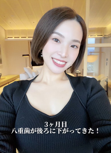 ワイヤー矯正ビフォアフ