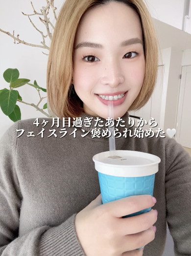 ワイヤー矯正ビフォアフ