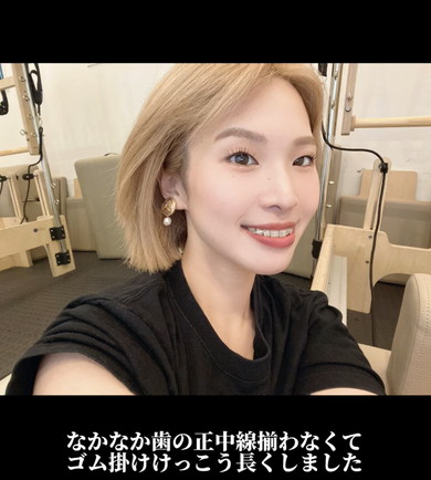 ワイヤー矯正ビフォアフ