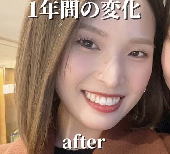 ワイヤー矯正ビフォアフ