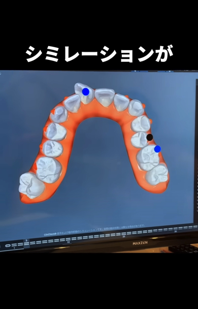 歯列矯正のシミレーション