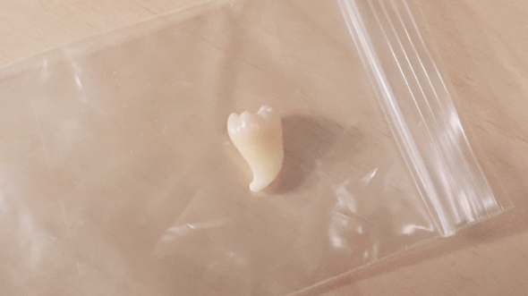 かわいい親知らず