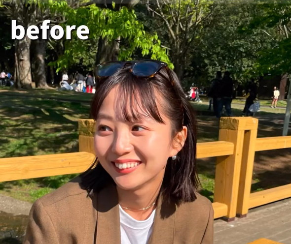 ワイヤー矯正ビフォーアフター