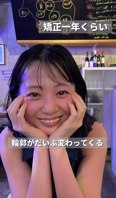 ワイヤー矯正ビフォーアフター