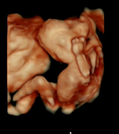 寝相がエコー写真と同じ