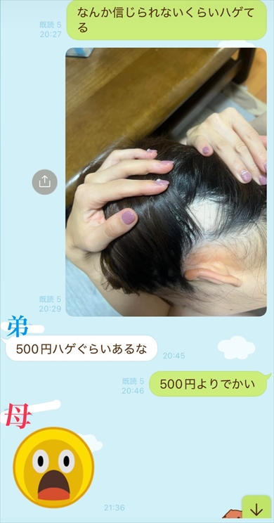家族に10円ハゲを伝えたときの反応