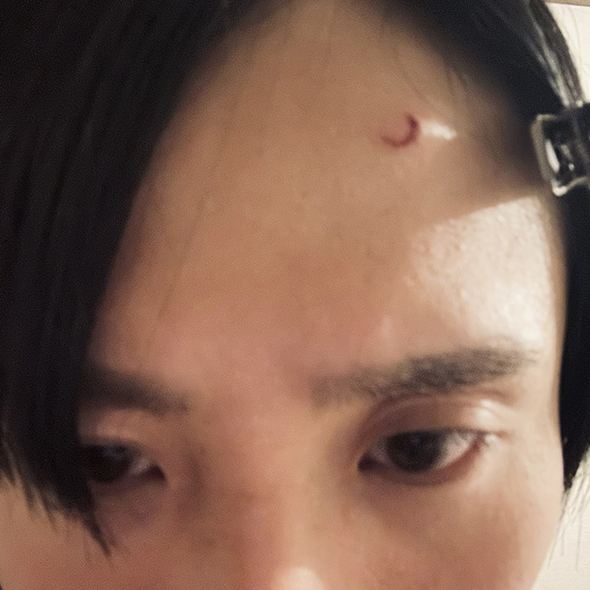 壁の突起におでこをぶつけたら……