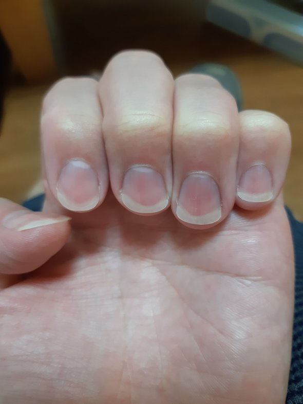 爪 ネイル ケア ビフォーアフター