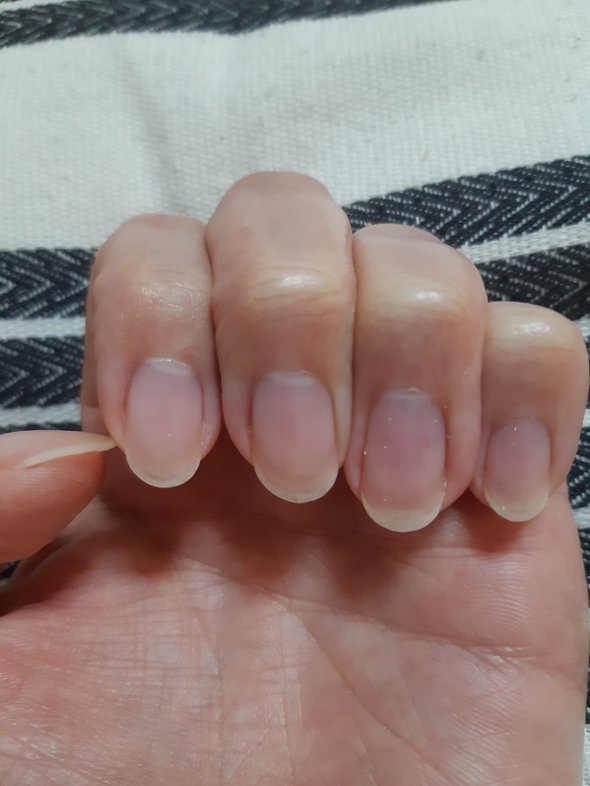 爪 ネイル ケア ビフォーアフター