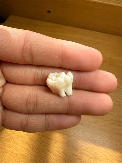 デカすぎる親知らず