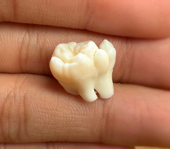 デカすぎる親知らず