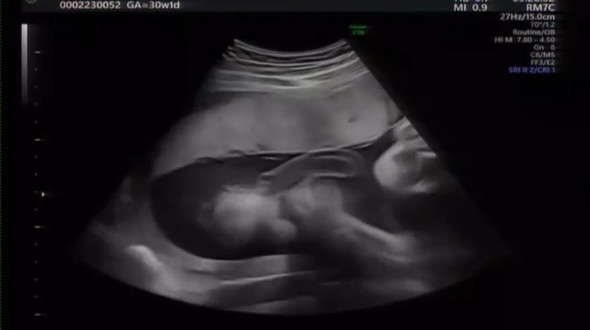 胎児のエコー動画