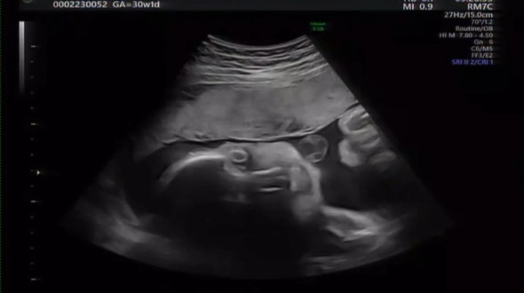 胎児エコー動画