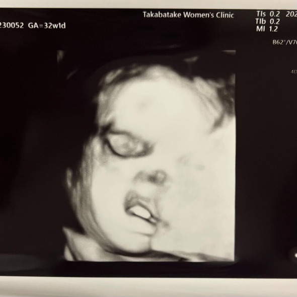 胎児エコー写真