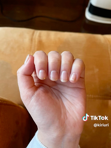 深爪を1年かけて矯正した記録