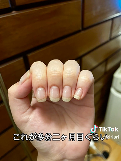 深爪を1年かけて矯正した記録