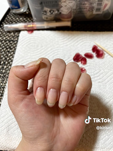 深爪を1年かけて矯正した記録