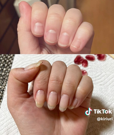 深爪を1年かけて矯正した記録